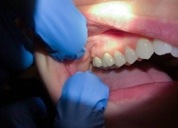 Best Lost Filling or Crown Replacement in Durant, IA
