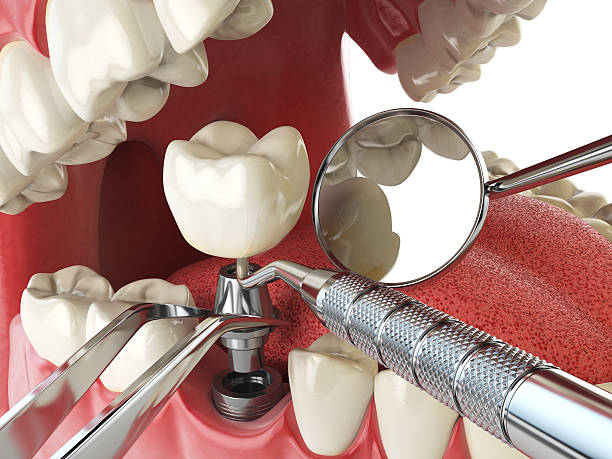 Best Emergency Wisdom Tooth Extraction in Durant, IA